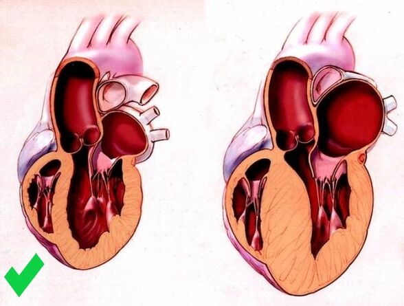 Cardione prevents cardiac ventricular hypertrophy