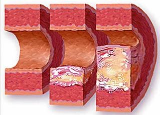 Stages of development of atherosclerotic plaques in vessels with hypertension